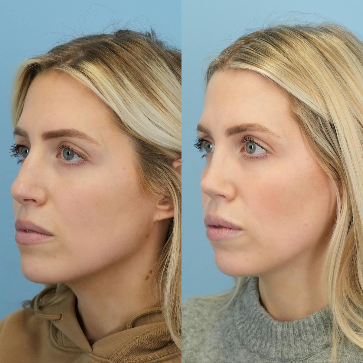 Rhinoplasty Before & After Gallery - Patient 127448 - Image 5