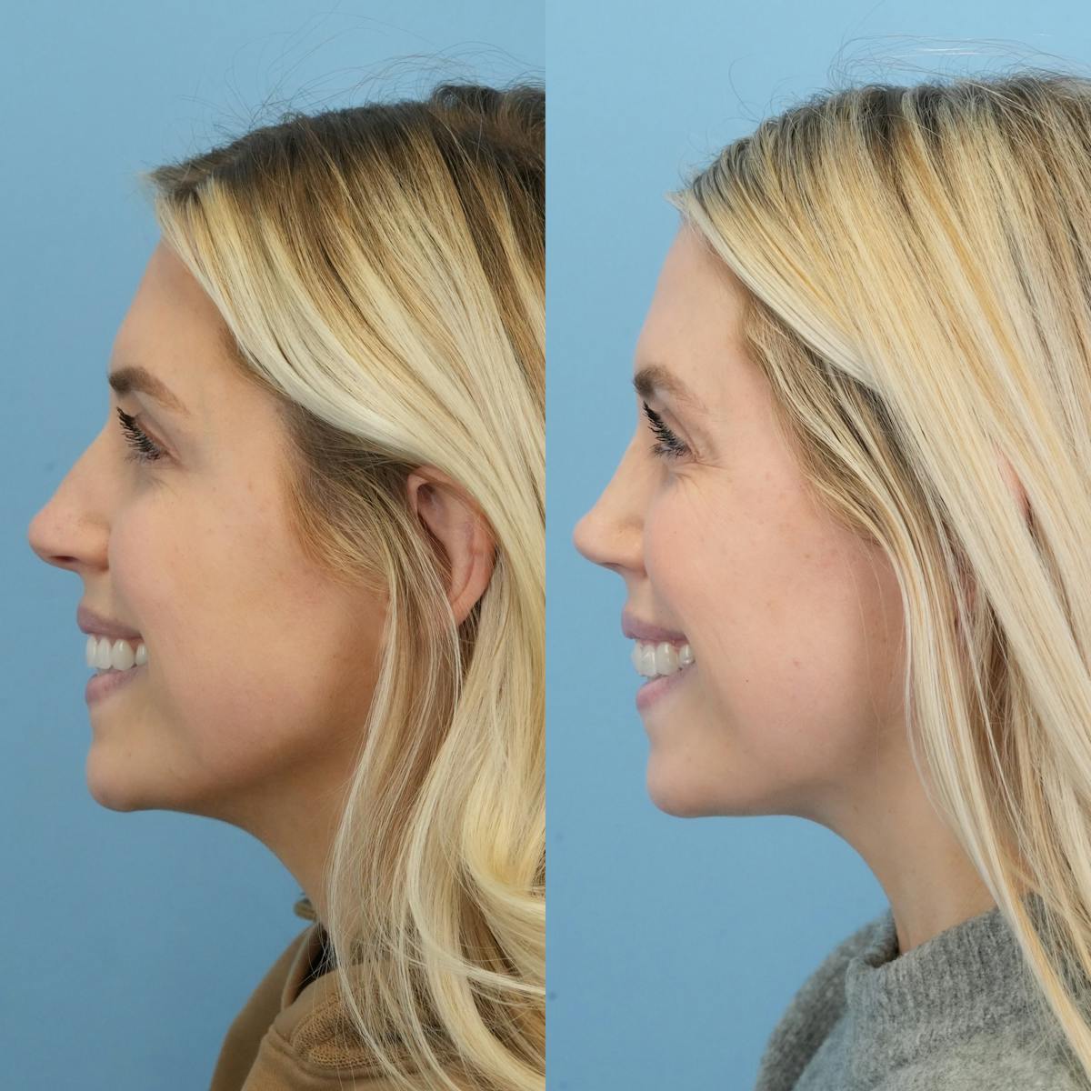 Rhinoplasty Before & After Gallery - Patient 127448 - Image 7