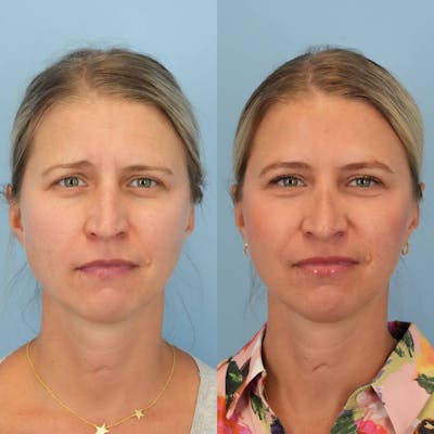 Rhinoplasty Before & After Gallery - Patient 913521 - Image 1