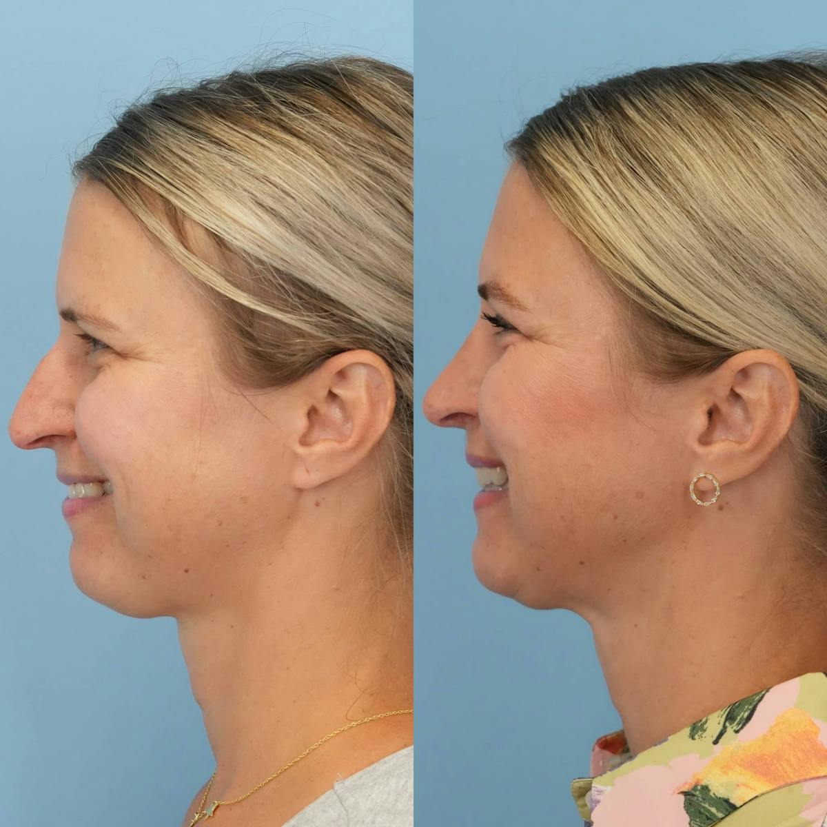 Rhinoplasty Before & After Gallery - Patient 913521 - Image 2