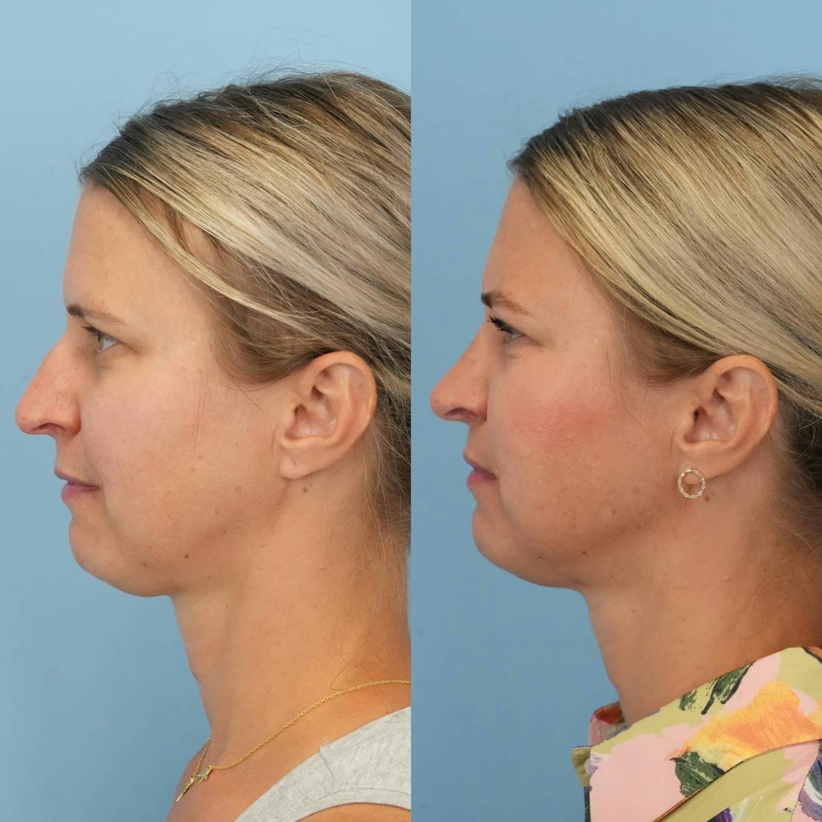 Rhinoplasty Before & After Gallery - Patient 913521 - Image 3