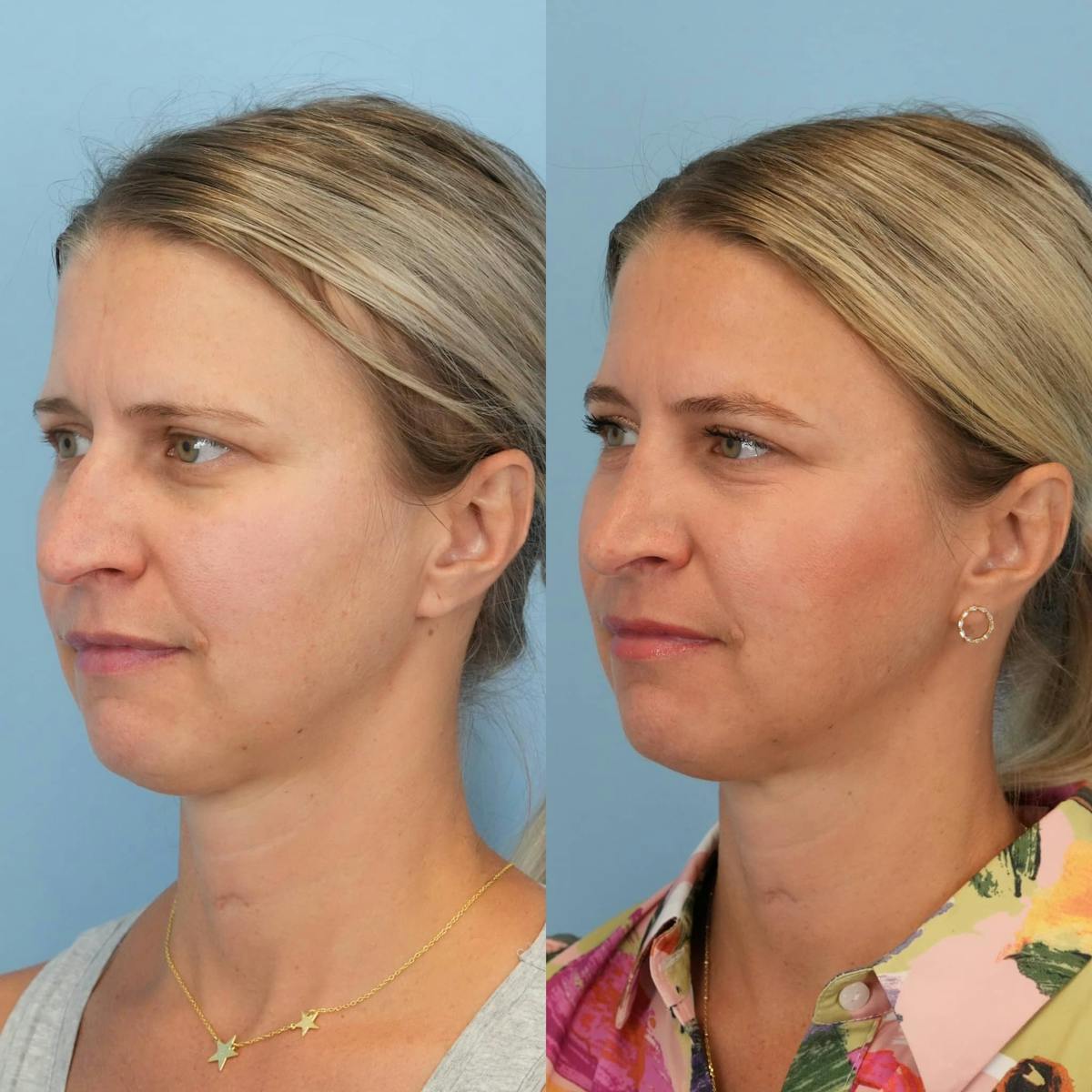 Rhinoplasty Before & After Gallery - Patient 913521 - Image 4
