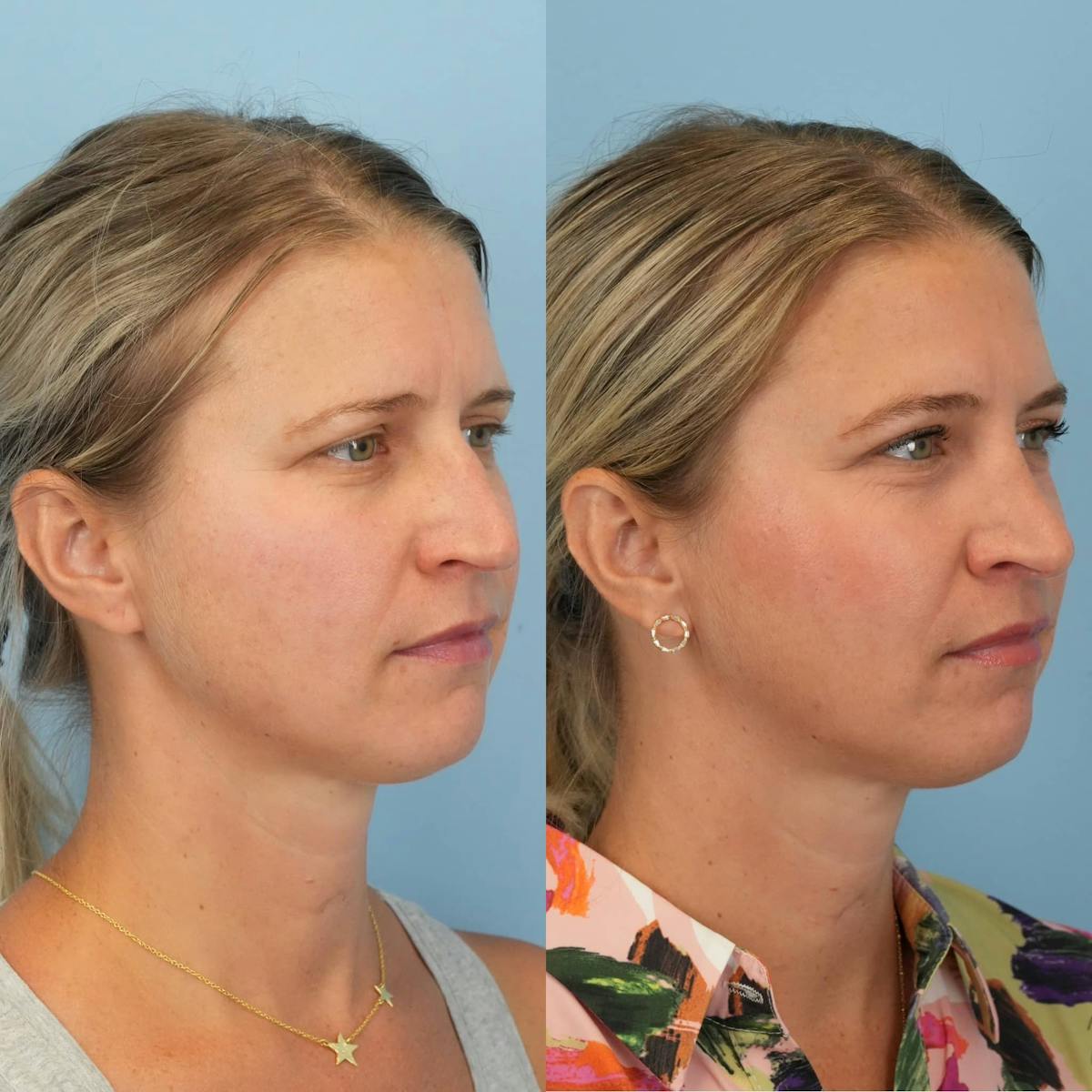 Rhinoplasty Before & After Gallery - Patient 913521 - Image 5
