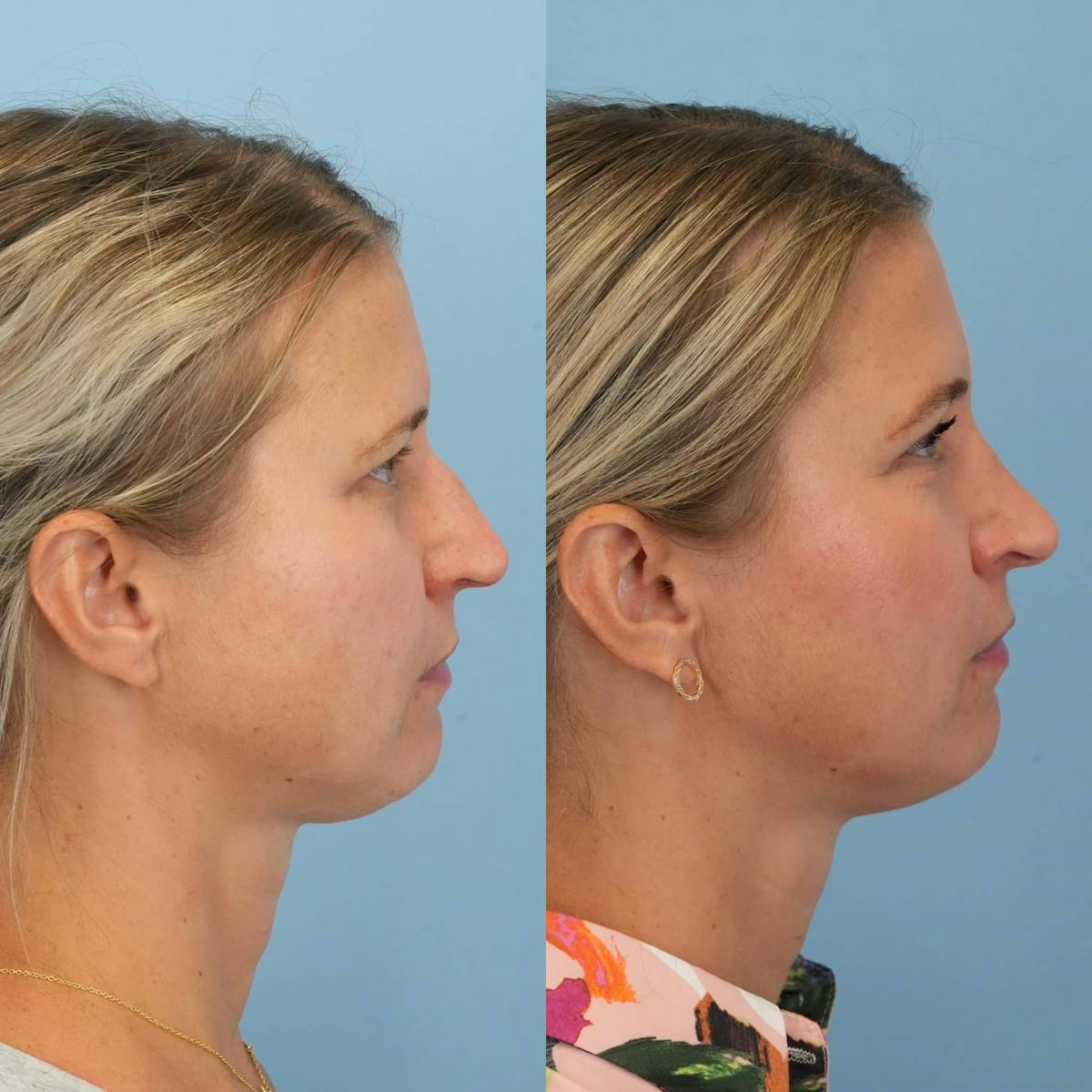 Rhinoplasty Before & After Gallery - Patient 913521 - Image 6