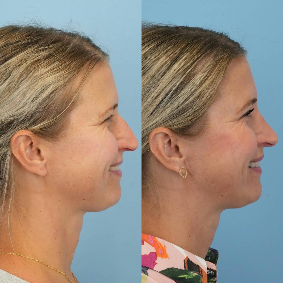 Rhinoplasty Before & After Gallery - Patient 913521 - Image 7