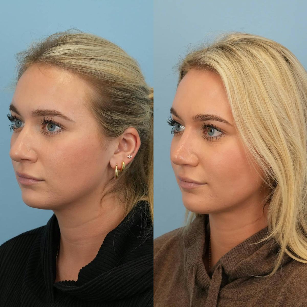 Rhinoplasty Before & After Gallery - Patient 144819 - Image 4