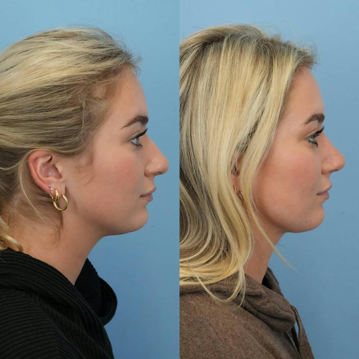 Rhinoplasty Before & After Gallery - Patient 144819 - Image 6