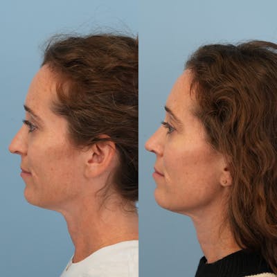 Revision Rhinoplasty Before & After Gallery - Patient 228268 - Image 1