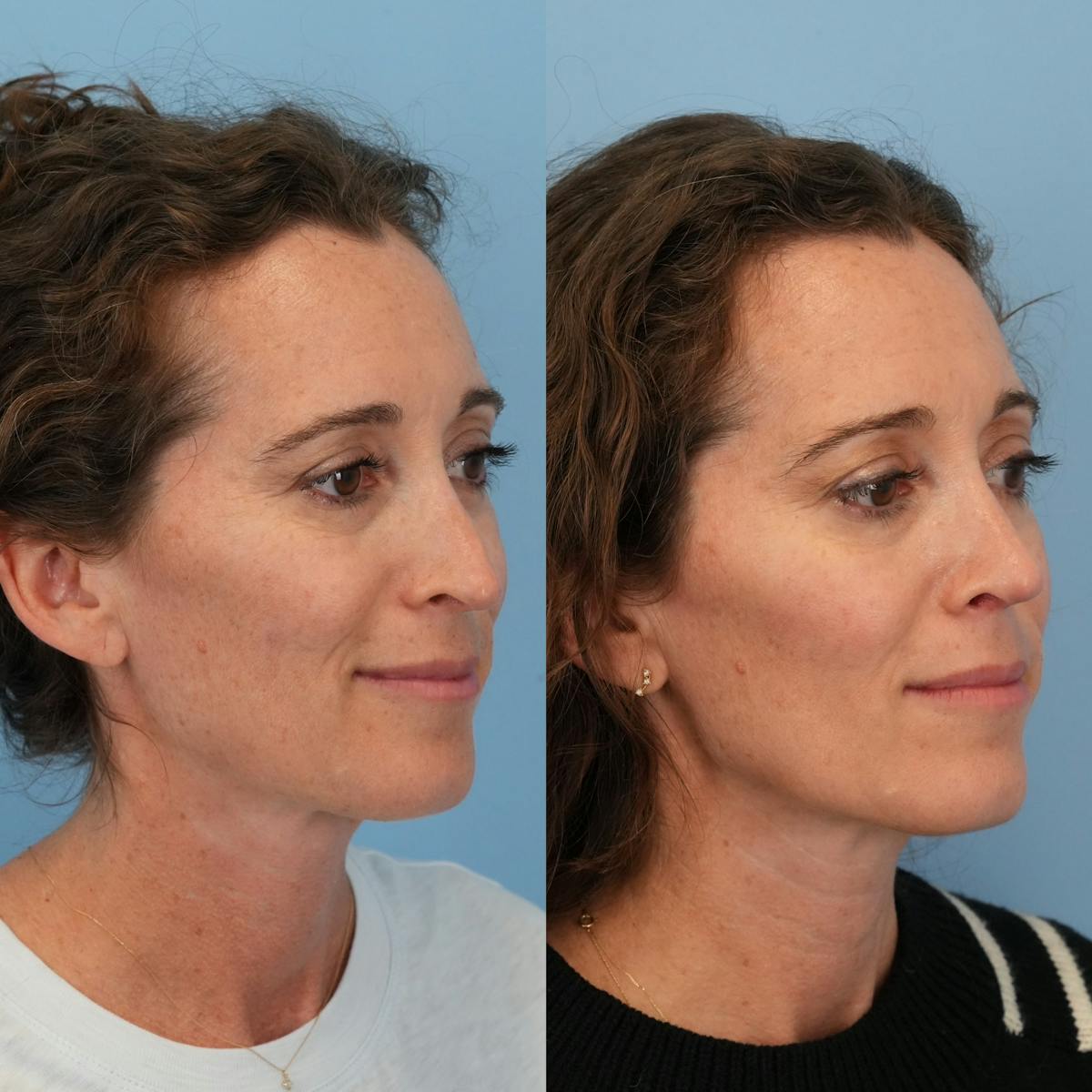 Revision Rhinoplasty Before & After Gallery - Patient 228268 - Image 6