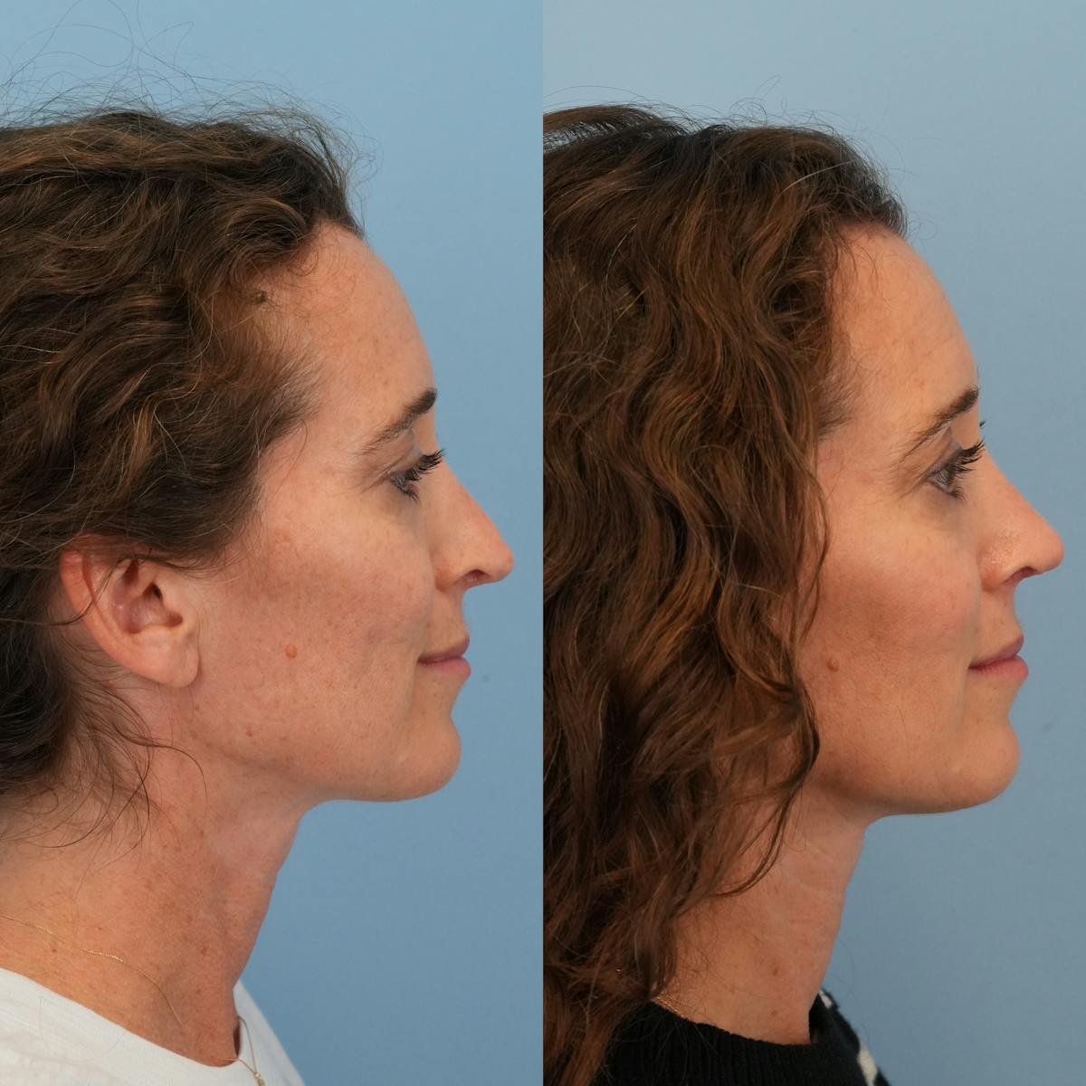 Revision Rhinoplasty Before & After Gallery - Patient 228268 - Image 7
