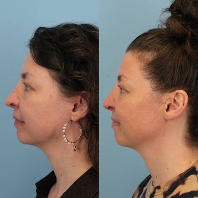 Revision Rhinoplasty Before & After Gallery - Patient 232966 - Image 1