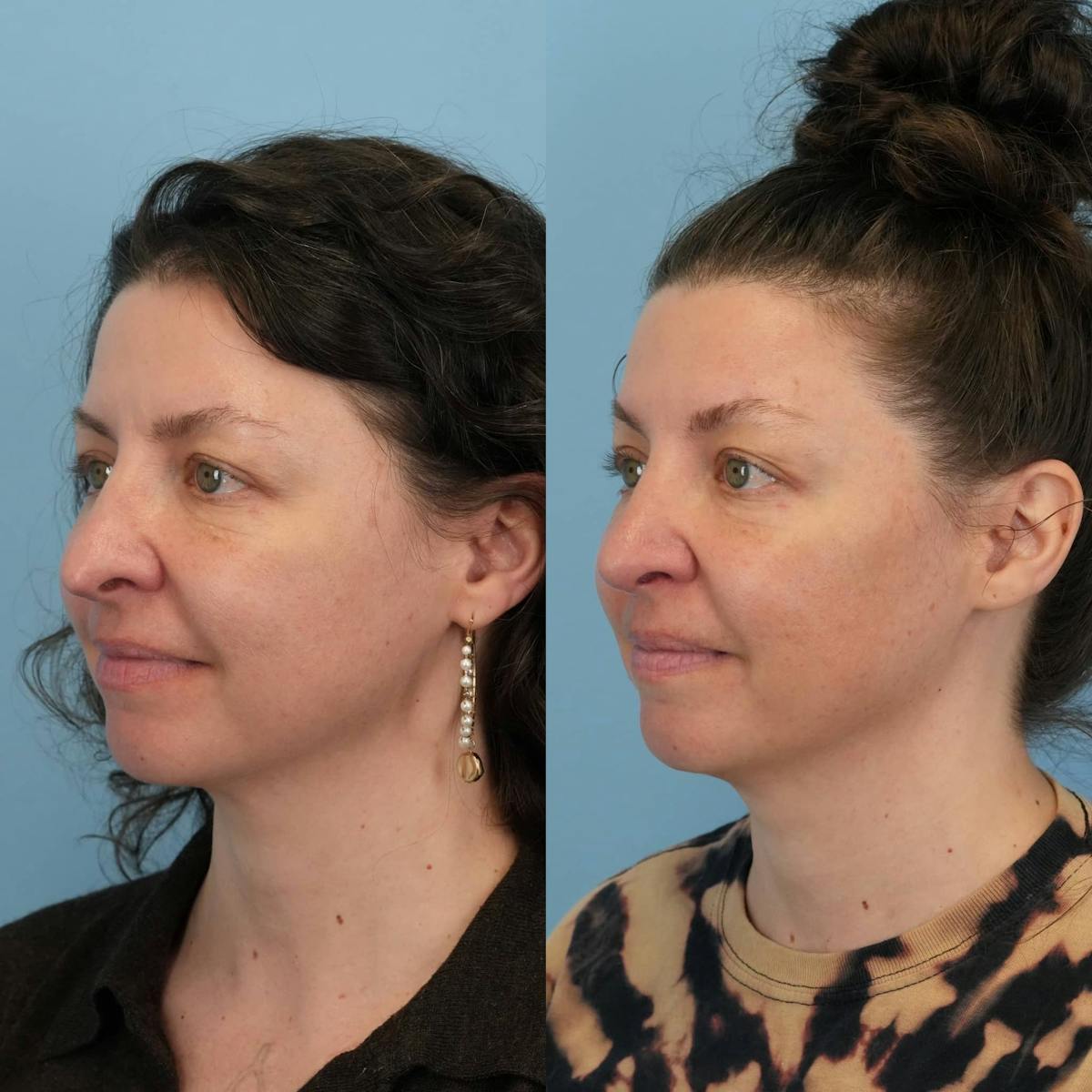 Revision Rhinoplasty Before & After Gallery - Patient 232966 - Image 3