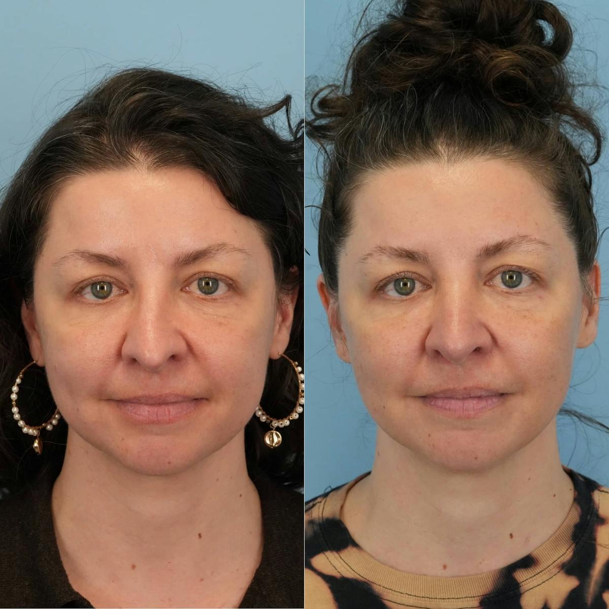Revision Rhinoplasty Before & After Gallery - Patient 232966 - Image 4