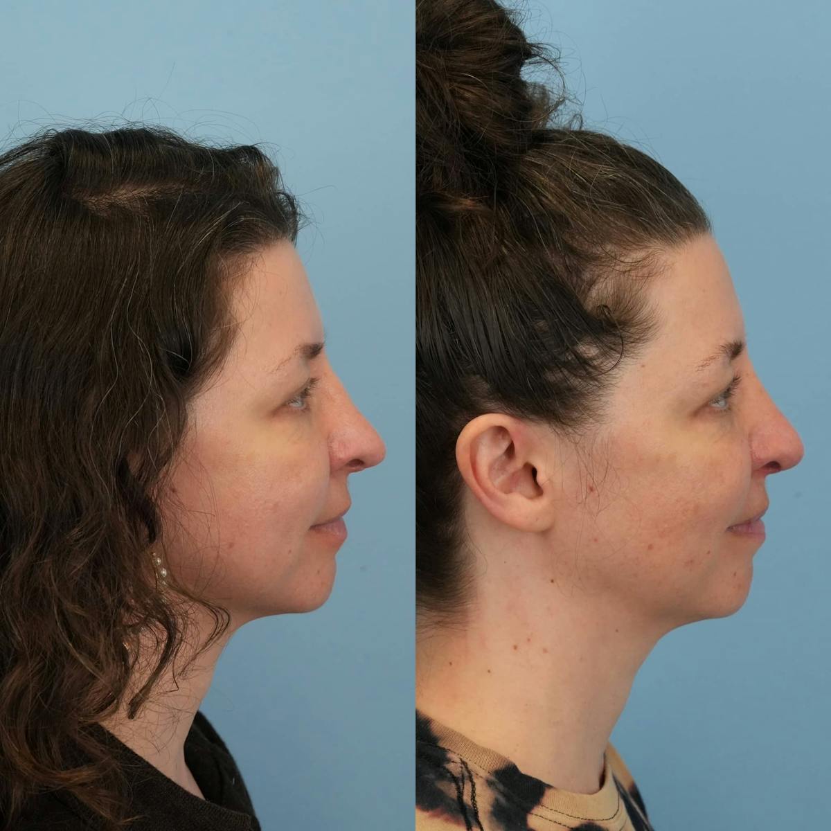 Revision Rhinoplasty Before & After Gallery - Patient 232966 - Image 5