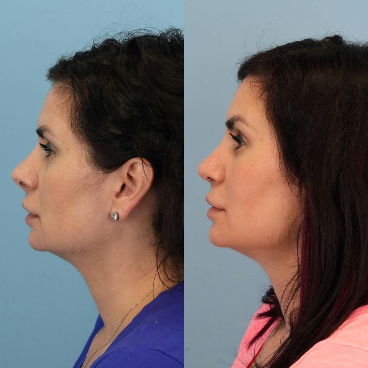 Revision Rhinoplasty Before & After Gallery - Patient 285271 - Image 1