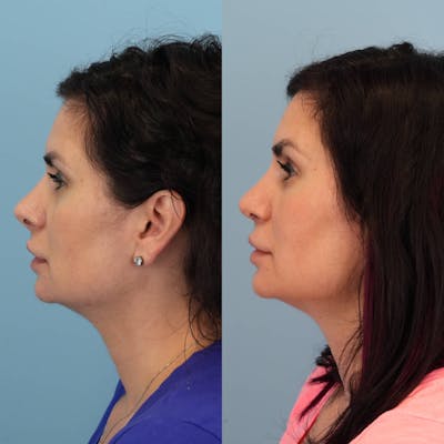 Revision Rhinoplasty Before & After Gallery - Patient 285271 - Image 1