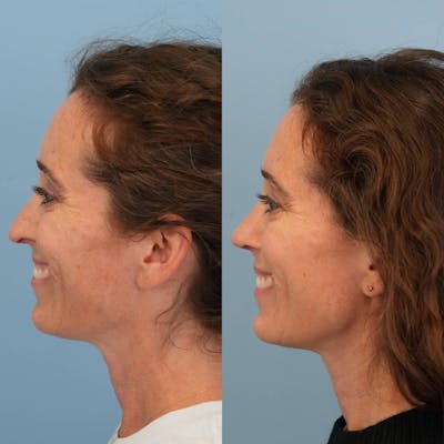 Revision Rhinoplasty Before & After Gallery - Patient 182345 - Image 1