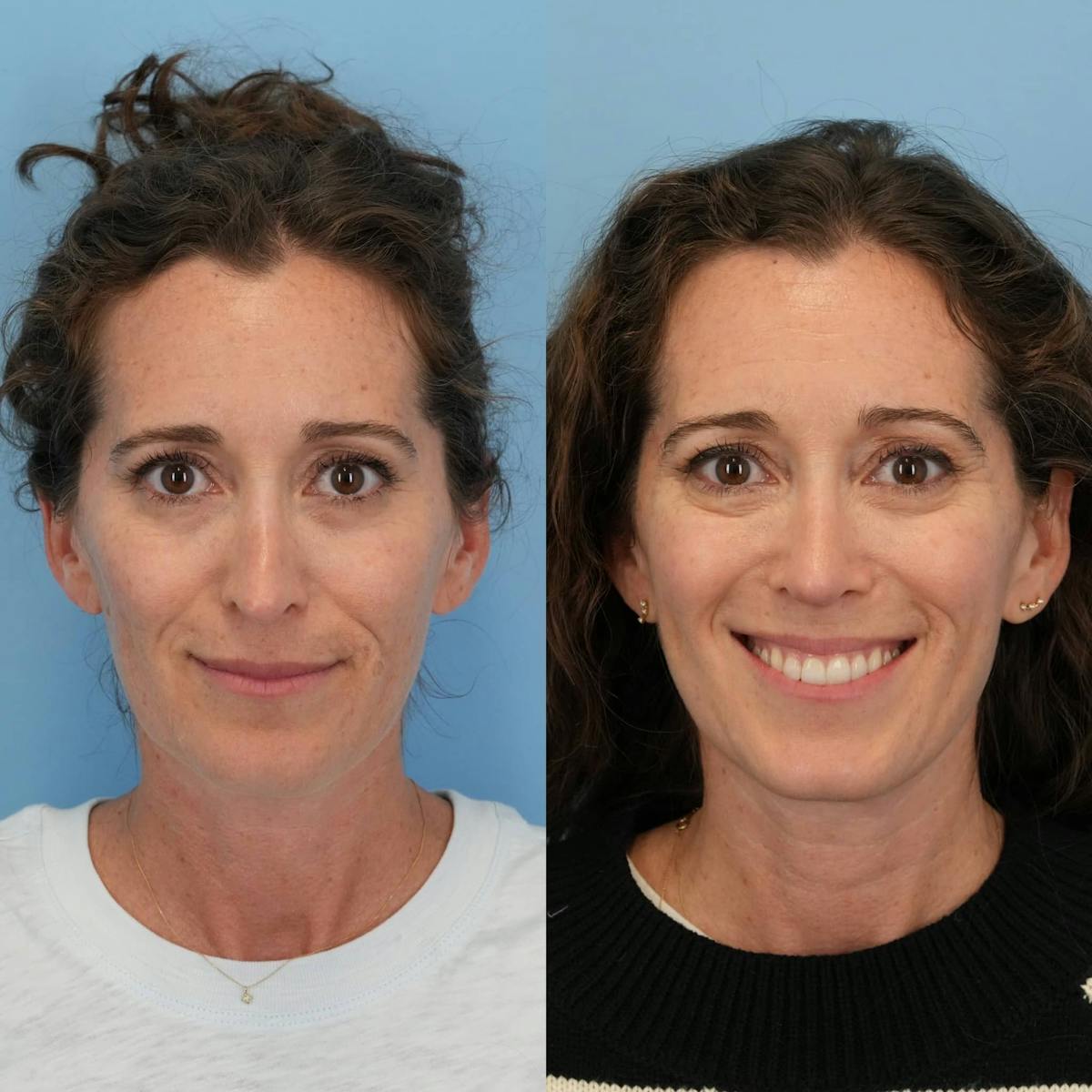 Revision Rhinoplasty Before & After Gallery - Patient 182345 - Image 5