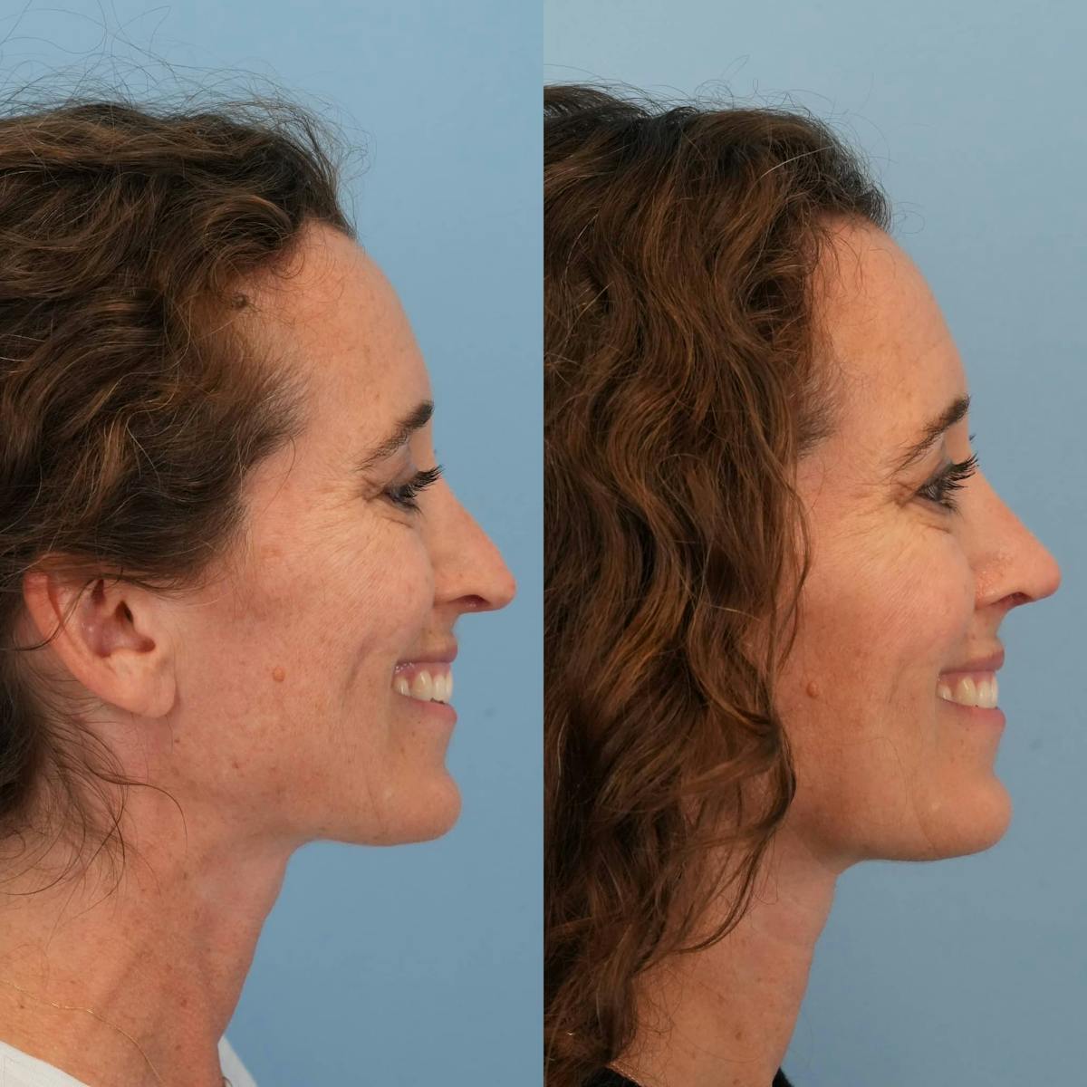 Revision Rhinoplasty Before & After Gallery - Patient 182345 - Image 7
