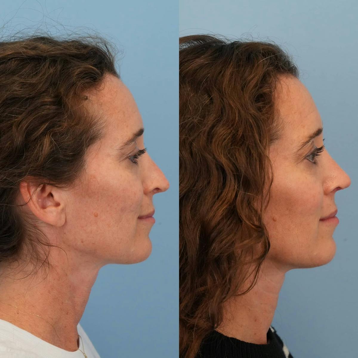 Revision Rhinoplasty Before & After Gallery - Patient 182345 - Image 8