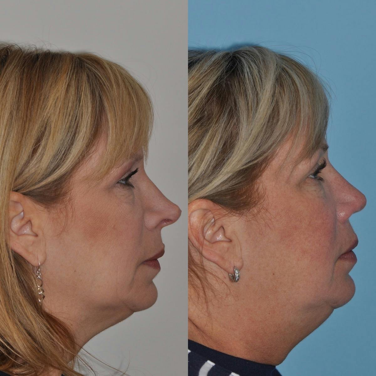 Revision Rhinoplasty Before & After Gallery - Patient 369331 - Image 2