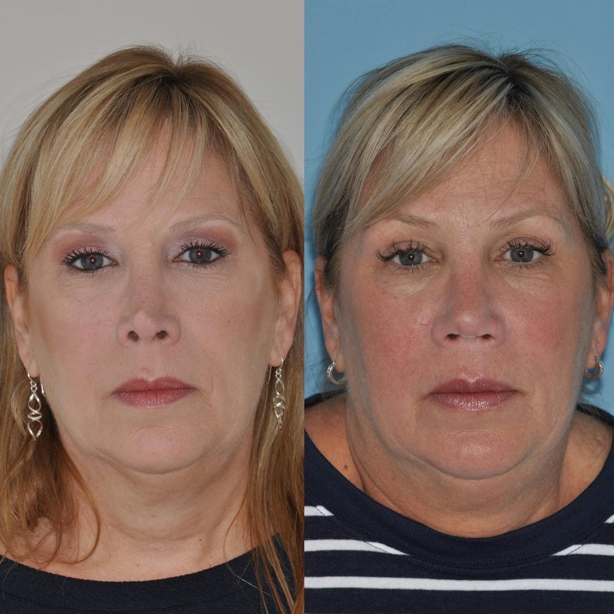 Revision Rhinoplasty Before & After Gallery - Patient 369331 - Image 3