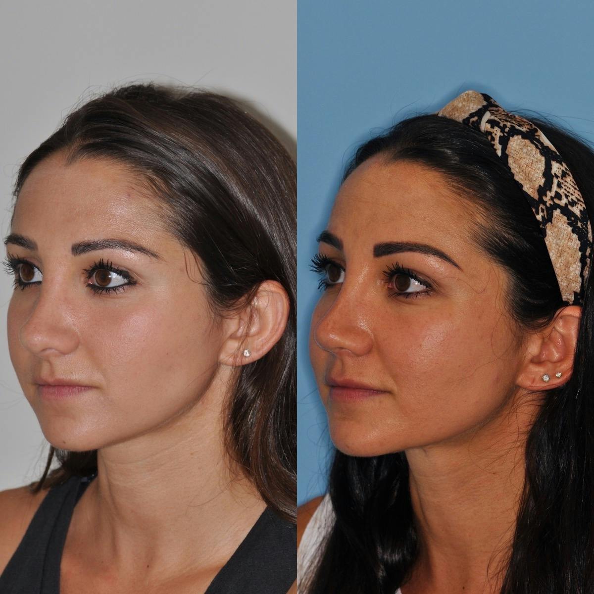 Revision Rhinoplasty Before & After Gallery - Patient 182305 - Image 2