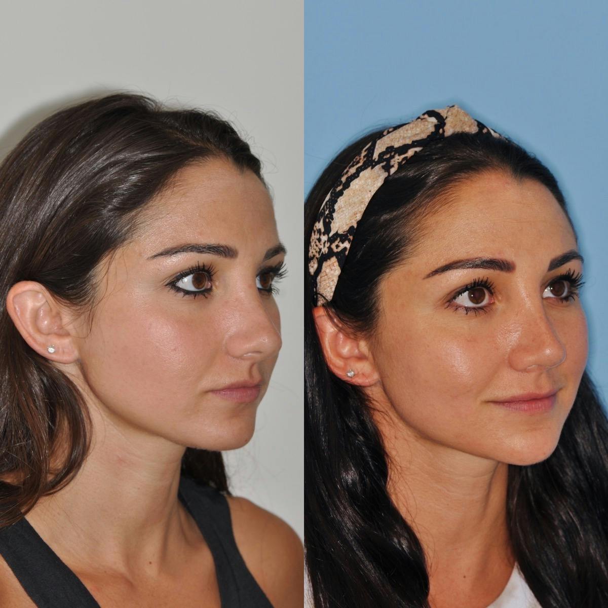 Revision Rhinoplasty Before & After Gallery - Patient 182305 - Image 5