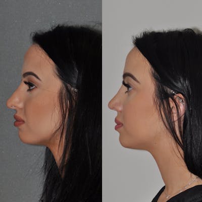 Revision Rhinoplasty Before & After Gallery - Patient 217845 - Image 1
