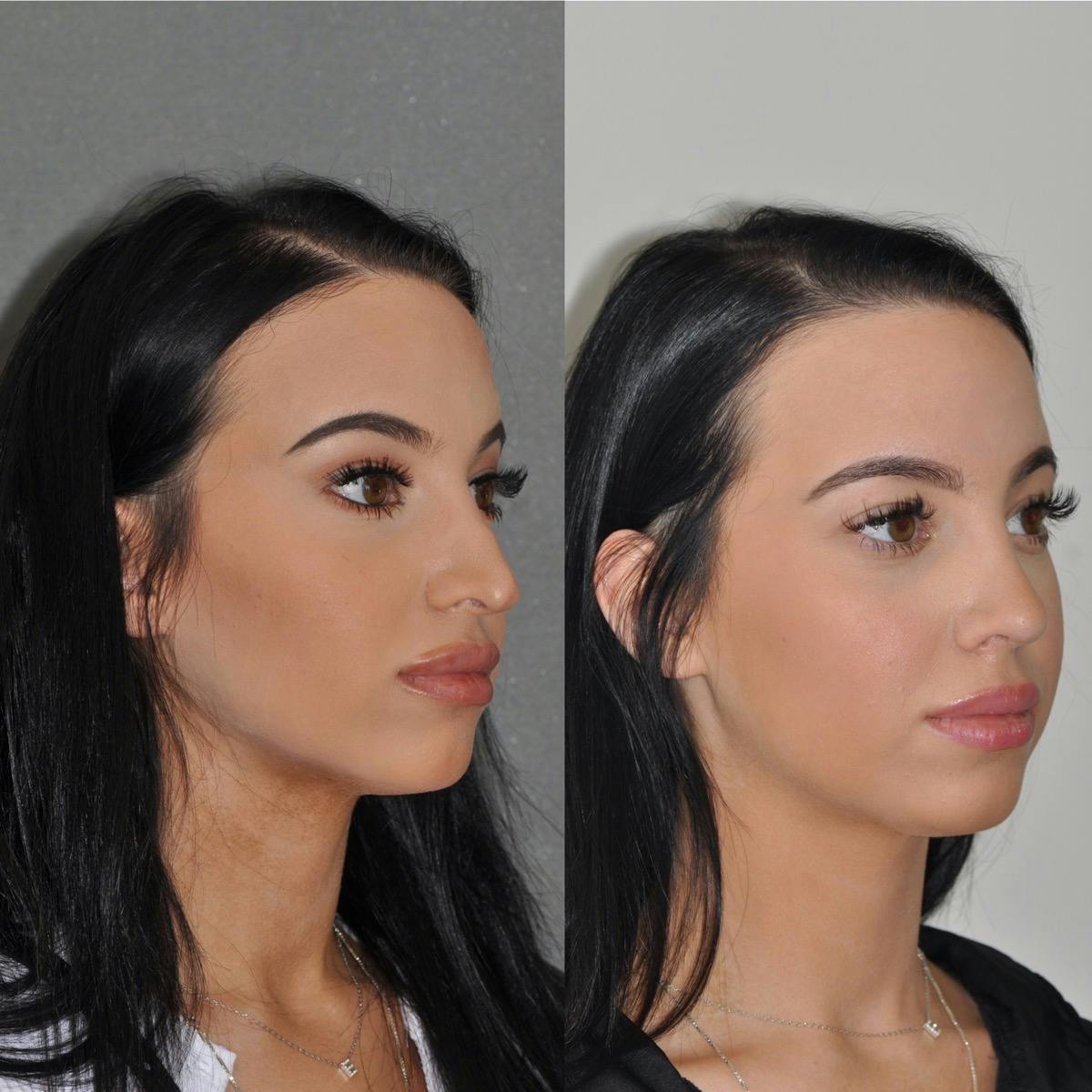 Revision Rhinoplasty Before & After Gallery - Patient 217845 - Image 4