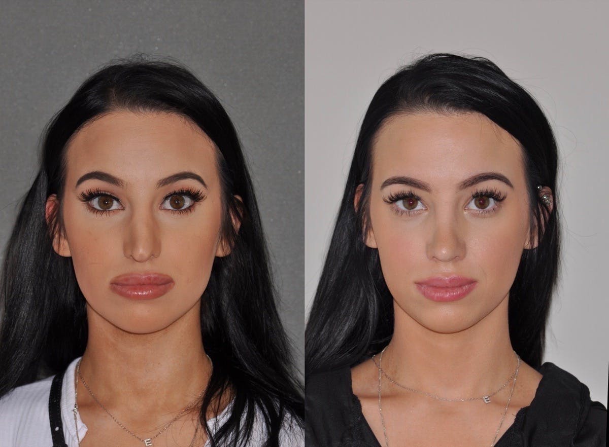Revision Rhinoplasty Before & After Gallery - Patient 217845 - Image 5
