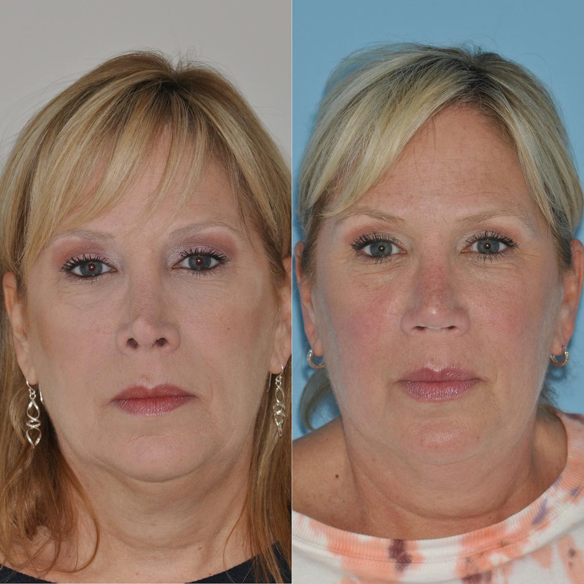 Revision Rhinoplasty Before & After Gallery - Patient 250286 - Image 1