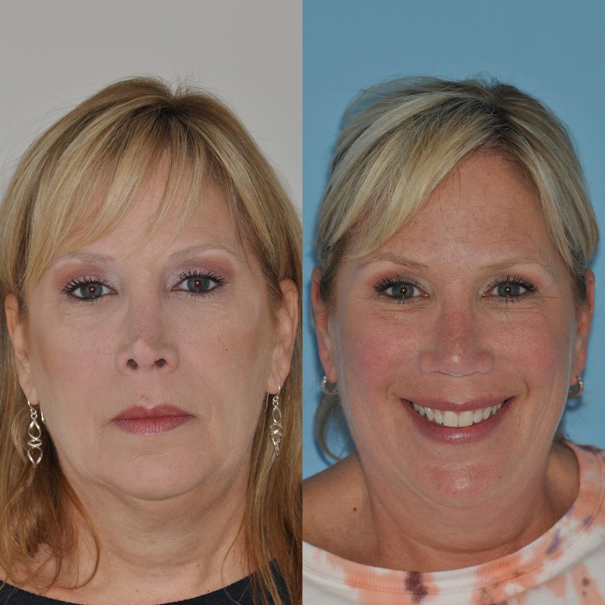 Revision Rhinoplasty Before & After Gallery - Patient 250286 - Image 5