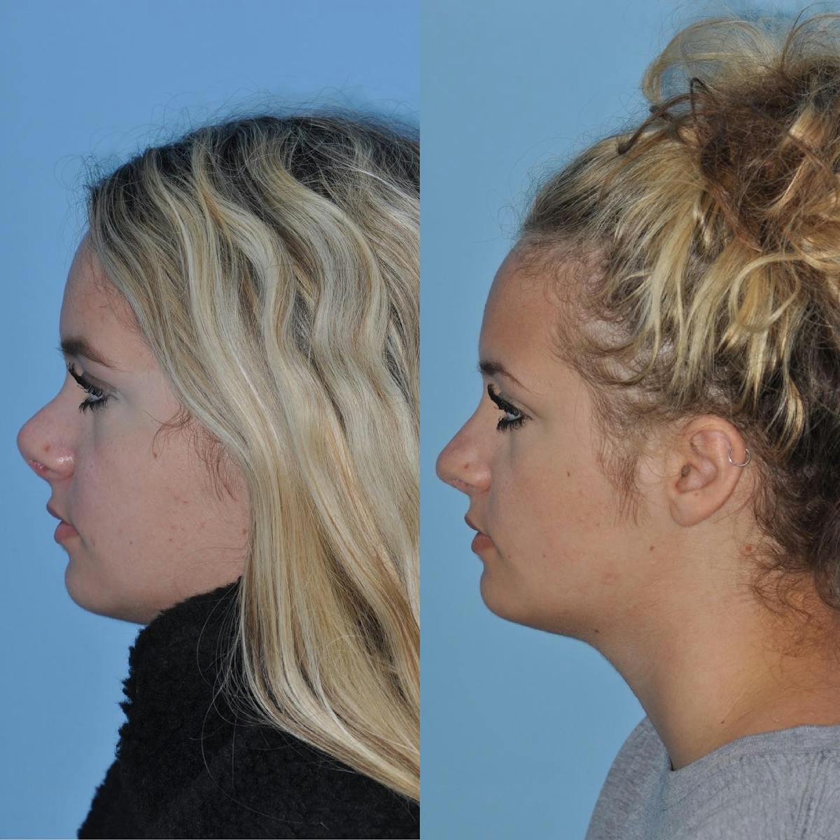 Revision Rhinoplasty Before & After Gallery - Patient 113799 - Image 2