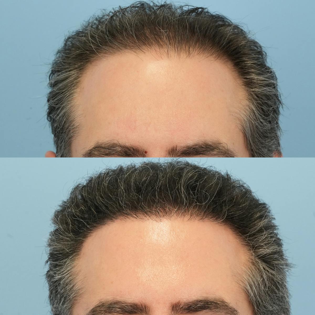 Hair Transplantation Before & After Gallery - Patient 295230 - Image 1