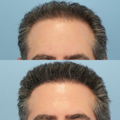 Hair Transplantation Before & After Gallery - Patient 295230 - Image 1