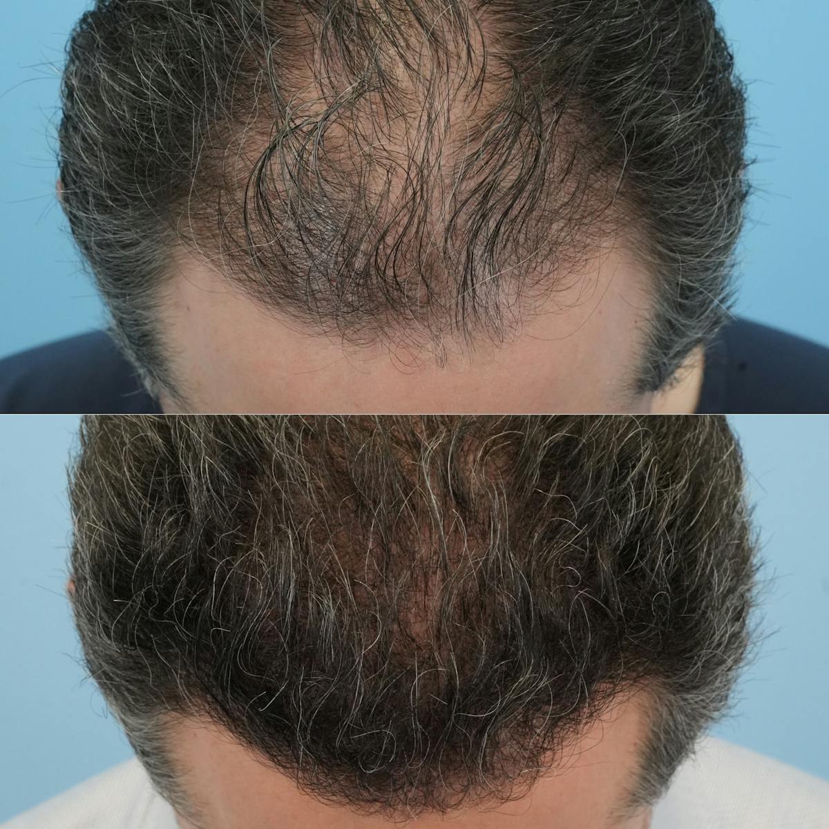 Hair Transplantation Before & After Gallery - Patient 295230 - Image 4