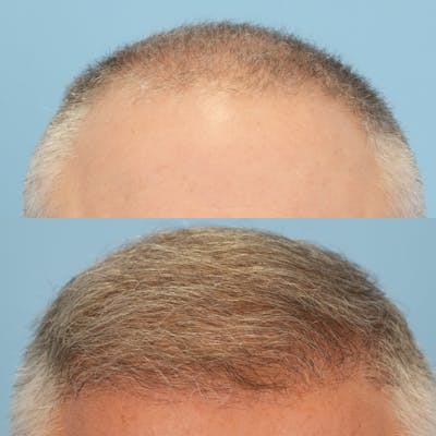 Hair Transplantation Before & After Gallery - Patient 141610 - Image 1