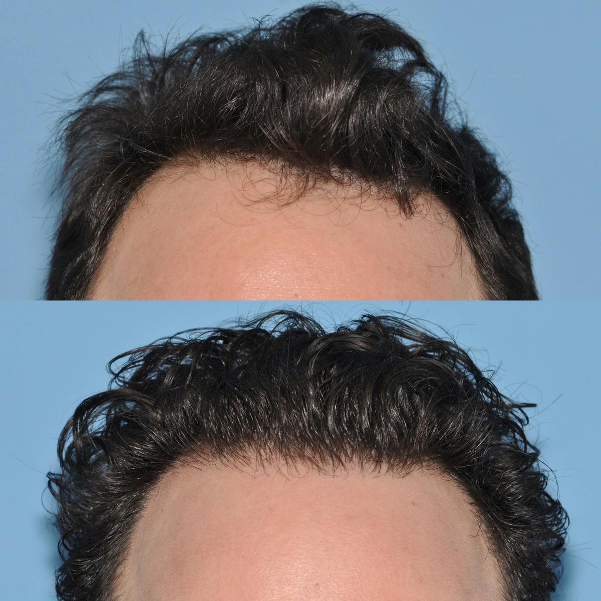 Hair Transplantation Before & After Gallery - Patient 195845 - Image 1