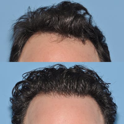 Hair Transplantation Before & After Gallery - Patient 195845 - Image 1