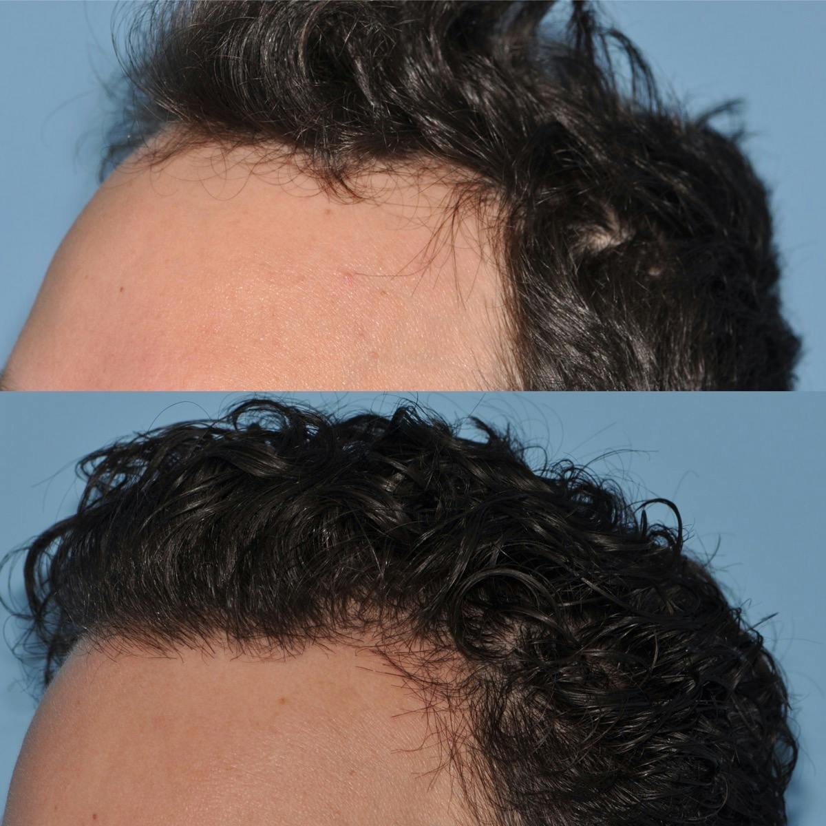 Hair Transplantation Before & After Gallery - Patient 195845 - Image 2