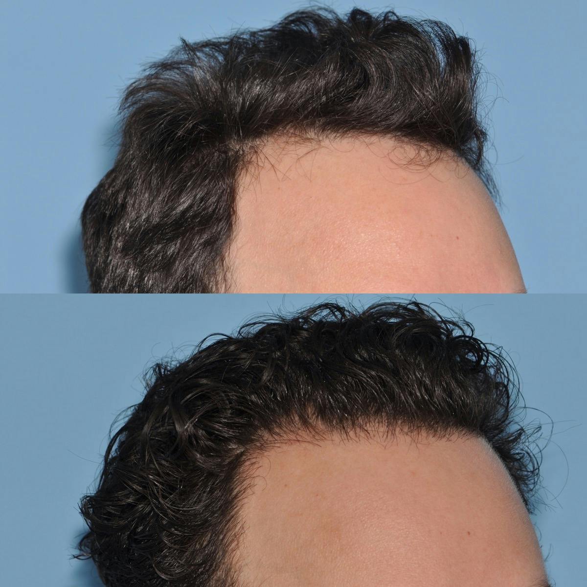 Hair Transplantation Before & After Gallery - Patient 195845 - Image 3