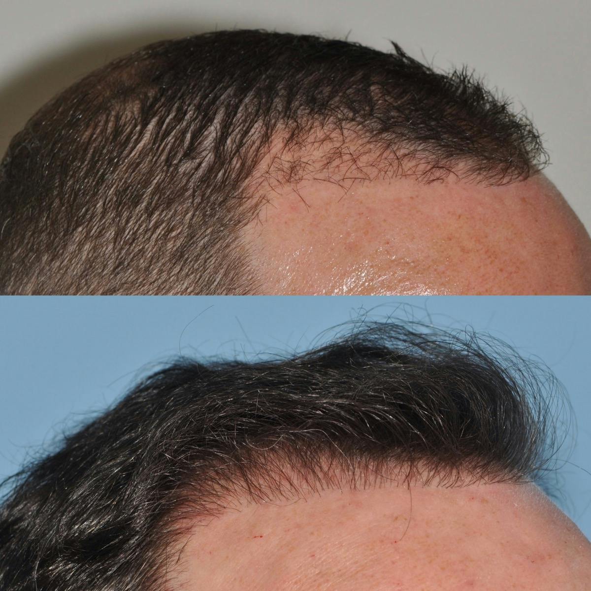 Hair Transplantation Before & After Gallery - Patient 107134 - Image 1