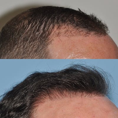 Hair Transplantation Before & After Gallery - Patient 107134 - Image 1
