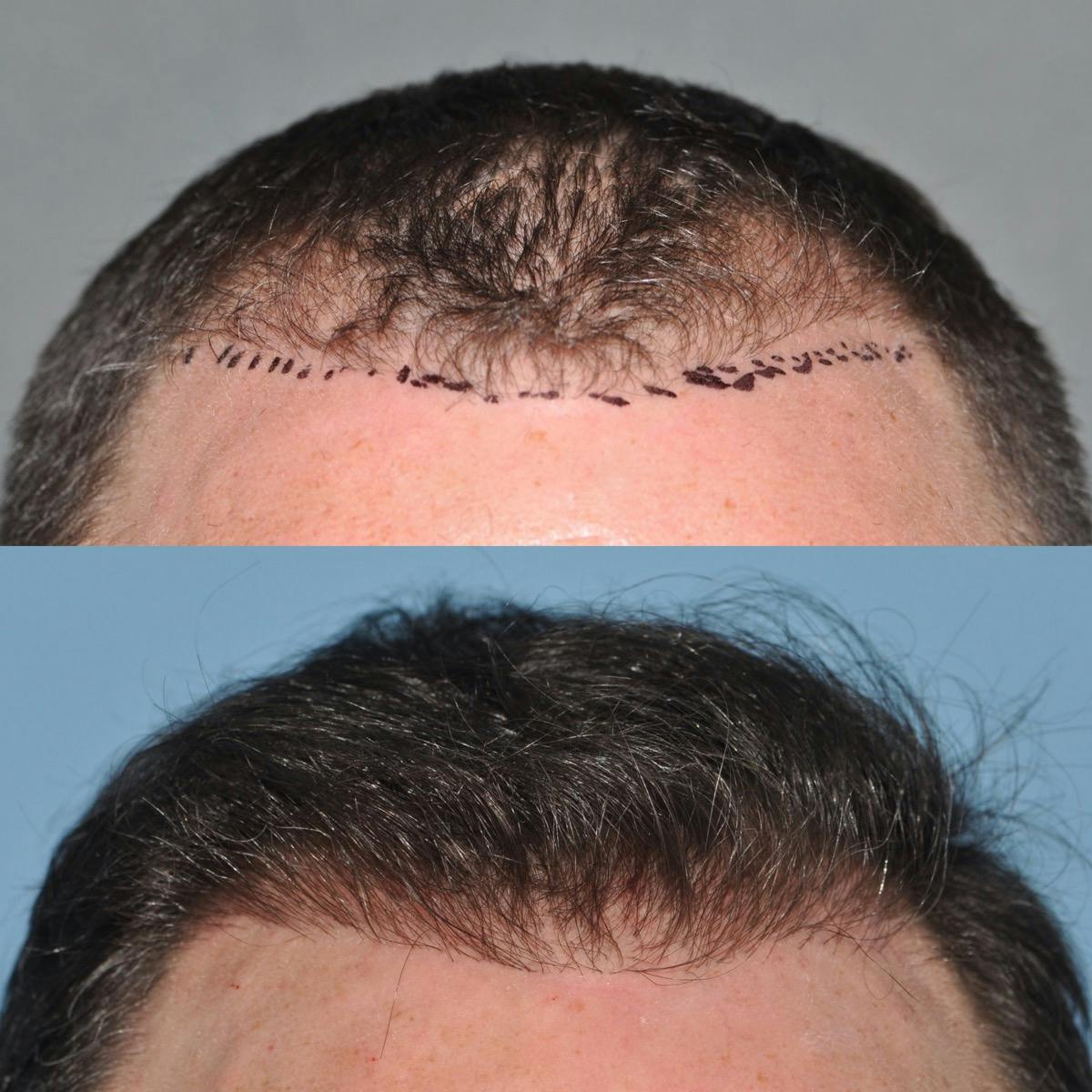 Hair Transplantation Before & After Gallery - Patient 107134 - Image 2