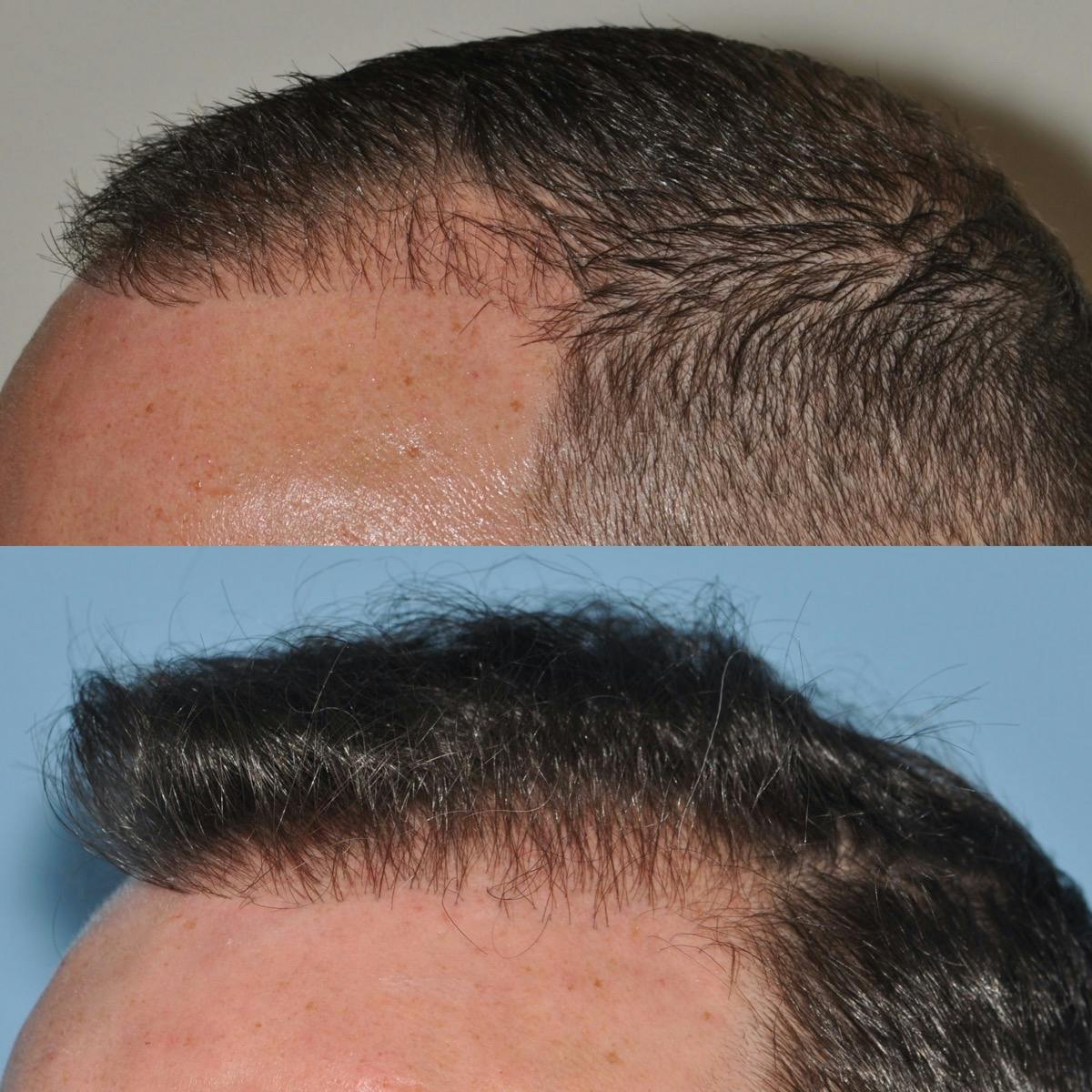 Hair Transplantation Before & After Gallery - Patient 107134 - Image 3
