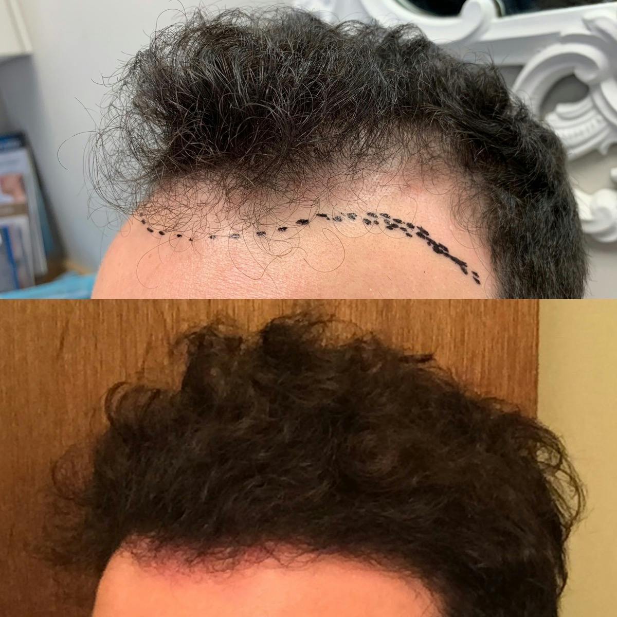 Hair Transplantation Before & After Gallery - Patient 153303 - Image 2