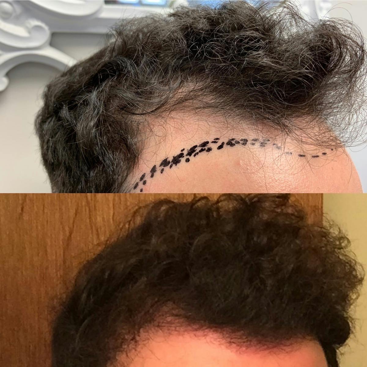 Hair Transplantation Before & After Gallery - Patient 153303 - Image 3