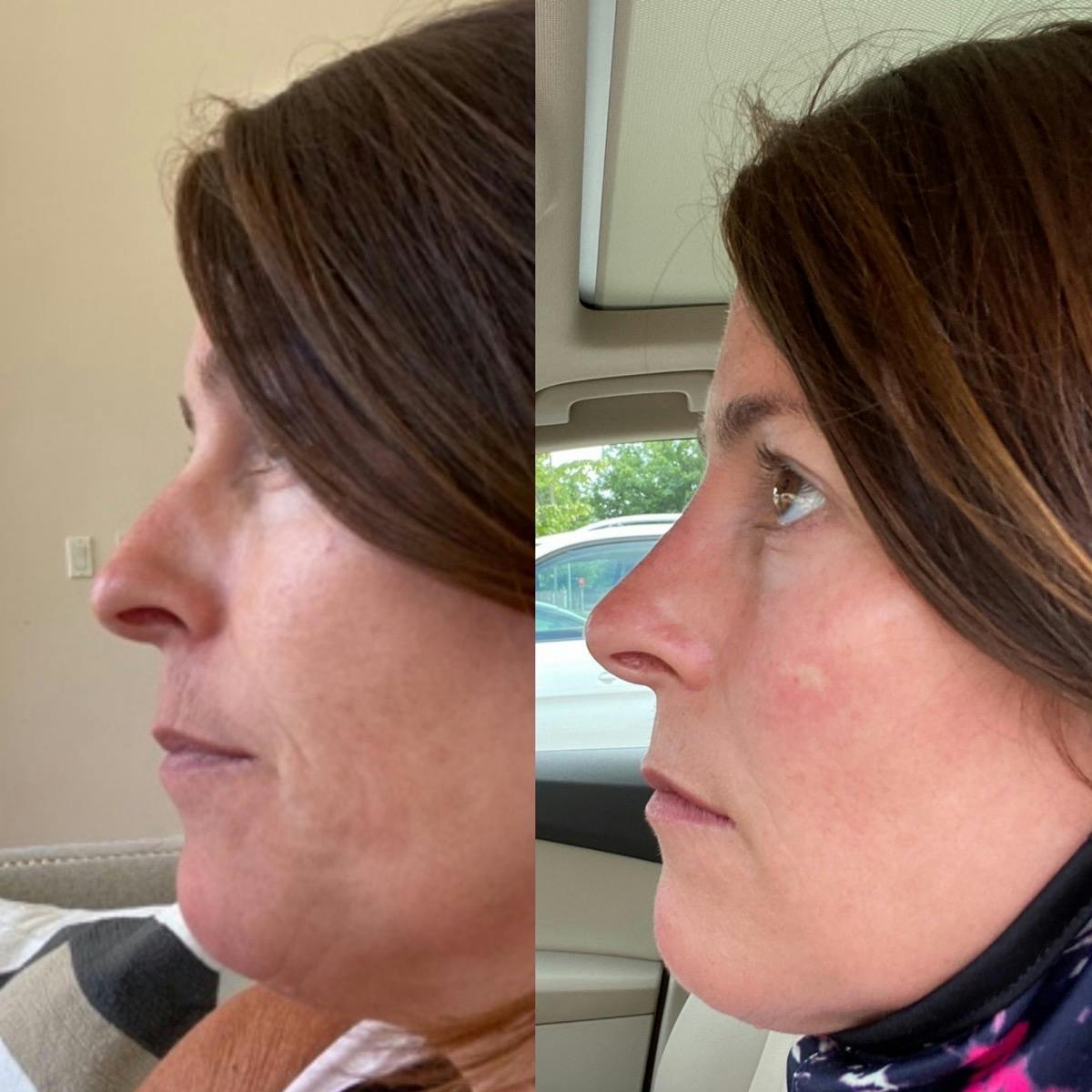 Non-Surgical Rhinoplasty Before & After Gallery - Patient 690284 - Image 6