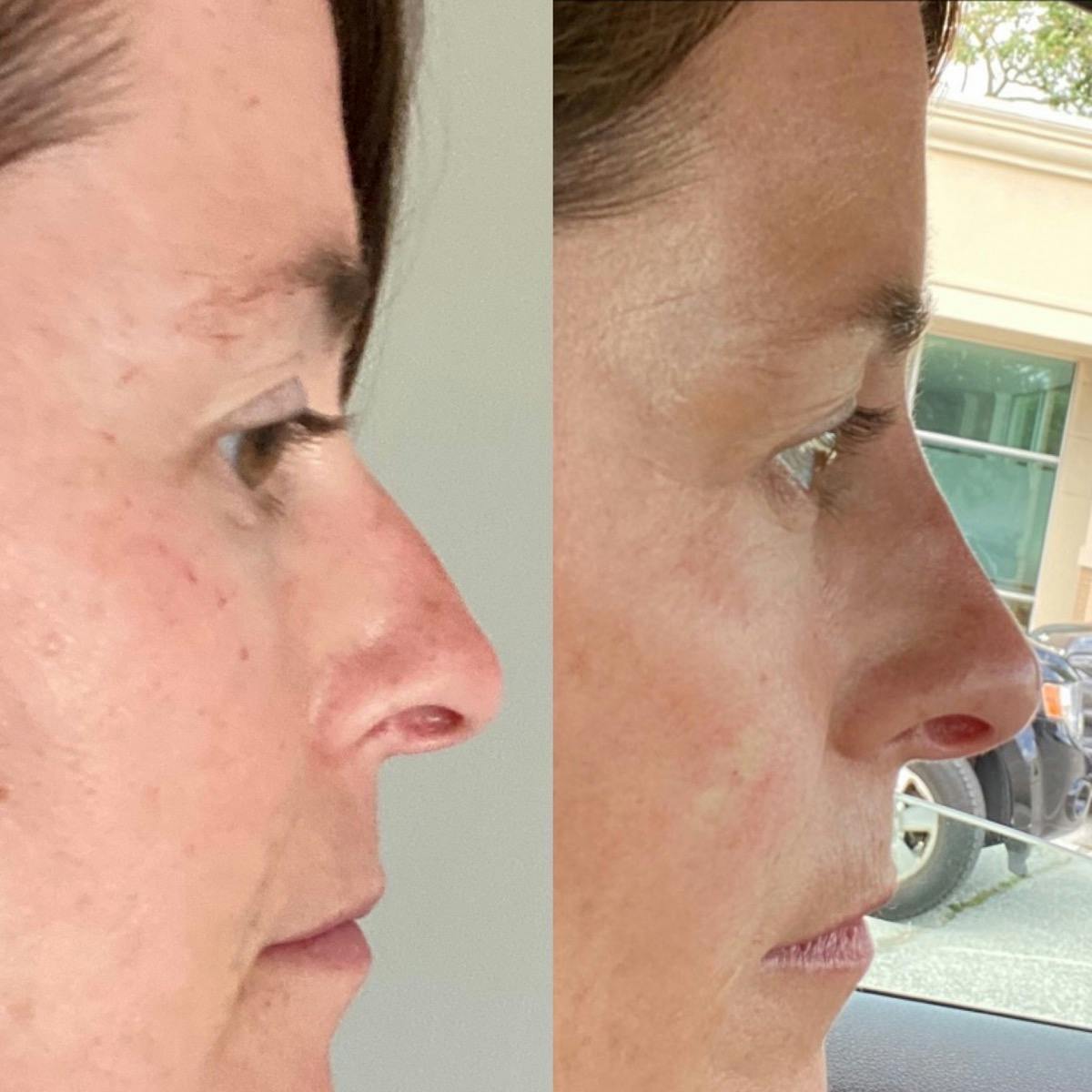 Non-Surgical Rhinoplasty Before & After Gallery - Patient 690284 - Image 7